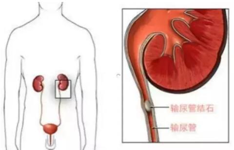 輸尿管結(jié)石，到底能不能保守治療？