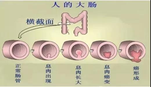 體檢發(fā)現(xiàn)腸息肉會癌變嗎？